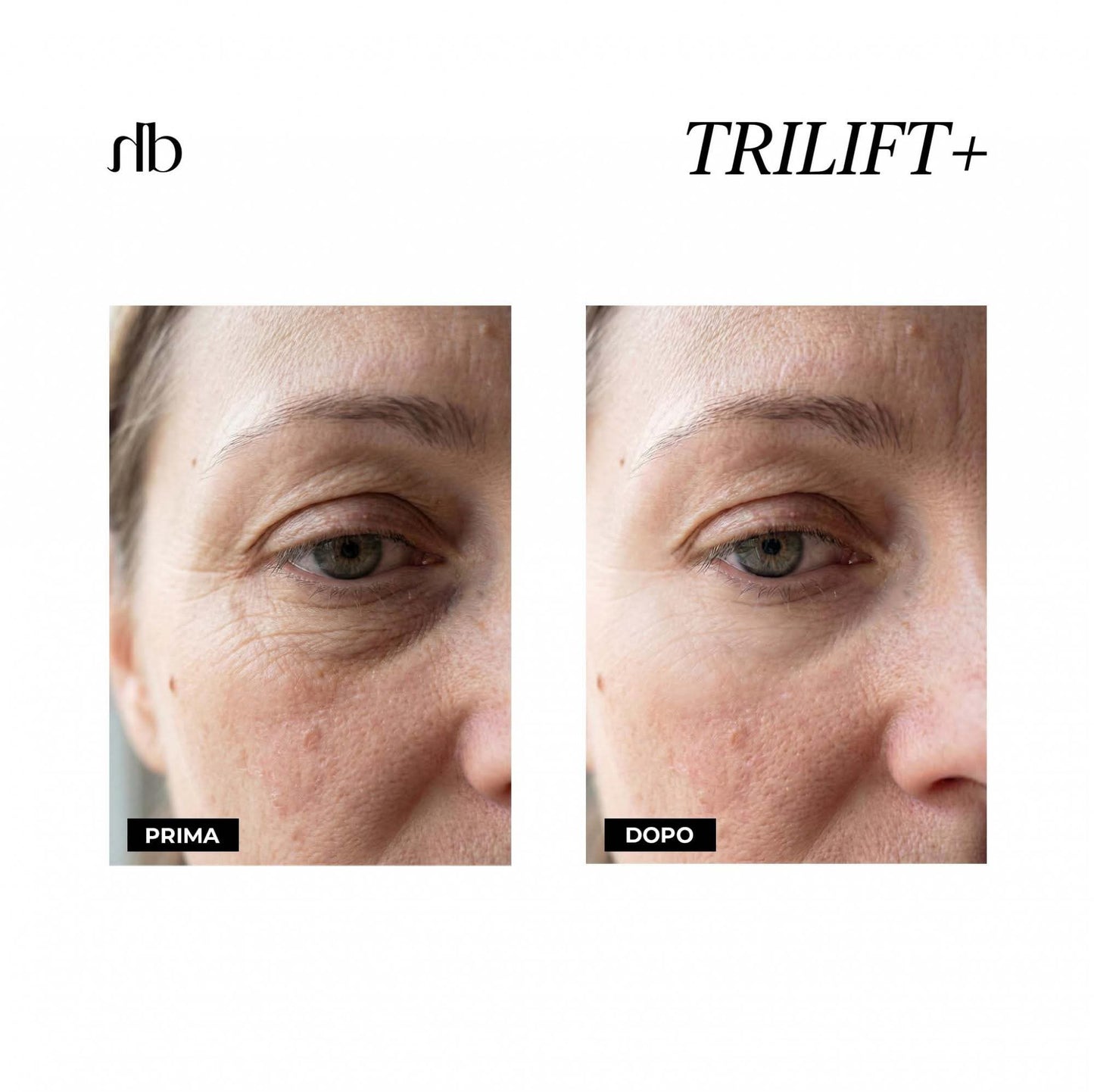 TRILIFT+ - 3-in-1 Augenpflege AntiAge Soforteffekt ohne Botox 10ml